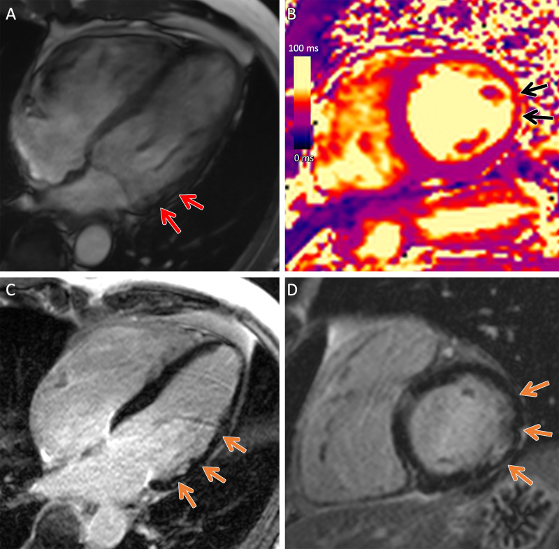 Arrhythmogenic cardiomyopathy with TMEM43 pathogenic variant (p.Ser358Leu). Cardiac 3-T MR images in a male patient between 50 and 59 years of age (exact age not provided due to potential reidentification risk) with chest pain and premature ventricular beats at Holter monitoring. The patient had a family history of arrhythmogenic cardiomyopathy. (A) Four-chamber steady-state free precession MR image demonstrates subepicardial chemical shift artifact along the basal to midventricular lateral left ventricular wall (red arrows). (B) Native T2 map demonstrates regional high T2 values at the midventricular inferolateral wall (black arrows). (C) Four-chamber and (D) short-axis late gadolinium enhancement images demonstrate subepicardial late gadolinium enhancement involving the basal to midventricular anterolateral and inferolateral wall (orange arrows).