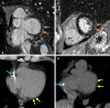TMEM43 arrhythmogenic cardiomyopathy. Cardiac CT and MR images in a
female patient between 50 and 59 years of age (exact age not provided due to
potential reidentification risk) with a TMEM43 variant of unknown
significance (p.Glu142Gly) with premature ventricular beats at Holter
monitoring. (A, B) Short-axis late gadolinium enhancement images at the (A)
base and (B) midventricle demonstrate subepicardial late gadolinium
enhancement involving the basal to mid inferolateral wall (orange arrows).
(C) Axial and (D) short-axis noncontrast cardiac CT images demonstrate
subepicardial fat along the lateral basal left ventricular wall (yellow
arrows) and right ventricular implantable cardioverter defibrillator lead
(blue arrows).