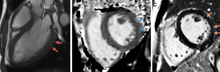 Arrhythmogenic cardiomyopathy with TMEM43 pathogenic variant (p.Ser358Leu). Short-axis 3-T MR images in a male patient between 18 and 19 years of age (exact age not provided due to potential reidentification risk) with palpitations and premature ventricular beats at Holter monitoring. He had a family history of arrhythmogenic cardiomyopathy in his grandfather, father, and brother. (A) Three-chamber steady-state free precession MR image demonstrates subepicardial chemical shift artifact along the basal to mid left ventricular inferolateral wall (red arrows). (B) Native T1 map demonstrates regional high T1 values at the subepicardial midventricular inferolateral wall (blue arrows). (C) There is subepicardial late gadolinium enhancement involving the midventricular anterior wall, anterolateral wall, and inferolateral wall (orange arrows).