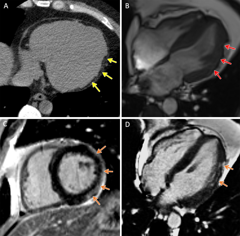 TMEM43 arrhythmogenic cardiomyopathy. Cardiac CT and MR images in a male patient between 30 and 39 years of age (exact age not provided due to potential reidentification risk) with a TMEM43 variant of unknown significance (p.Gly280Glu) with palpitations and premature ventricular beats at Holter monitoring. (A) Axial noncontrast cardiac CT image demonstrates extensive subepicardial fat along the lateral left ventricular wall (yellow arrows). (B) Four-chamber 1.5-T steady-state free precession MR image demonstrates subepicardial chemical shift artifact along the lateral left ventricular wall (red arrows). (C) Short-axis and (D) four-chamber late gadolinium enhancement images demonstrate subepicardial late gadolinium enhancement involving the midventricular anterolateral wall, inferolateral wall, and inferior wall (orange arrows).