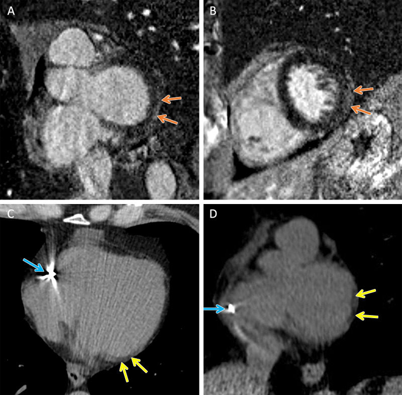 TMEM43 arrhythmogenic cardiomyopathy. Cardiac CT and MR images in a female patient between 50 and 59 years of age (exact age not provided due to potential reidentification risk) with a TMEM43 variant of unknown significance (p.Glu142Gly) with premature ventricular beats at Holter monitoring. (A, B) Short-axis late gadolinium enhancement images at the (A) base and (B) midventricle demonstrate subepicardial late gadolinium enhancement involving the basal to mid inferolateral wall (orange arrows). (C) Axial and (D) short-axis noncontrast cardiac CT images demonstrate subepicardial fat along the lateral basal left ventricular wall (yellow arrows) and right ventricular implantable cardioverter defibrillator lead (blue arrows).