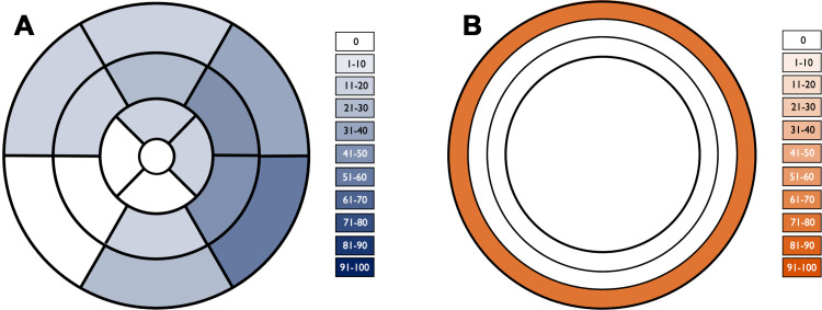 Segmental distribution of late gadolinium enhancement. (A) Color-shaded polar plot represents the percentage of patients with late gadolinium enhancement for each myocardial segment according to a standardized 17-segment model. (B) Color-shaded plot of the ventricular myocardium represents the percentage of patients with late gadolinium enhancement in each myocardial layer (from outer to inner: subepicardial, midwall, and subendocardial).