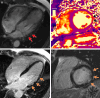 Arrhythmogenic cardiomyopathy with TMEM43 pathogenic variant
(p.Ser358Leu). Cardiac 3-T MR images in a male patient between 50 and 59
years of age (exact age not provided due to potential reidentification risk)
with chest pain and premature ventricular beats at Holter monitoring. The
patient had a family history of arrhythmogenic cardiomyopathy. (A)
Four-chamber steady-state free precession MR image demonstrates
subepicardial chemical shift artifact along the basal to midventricular
lateral left ventricular wall (red arrows). (B) Native T2 map demonstrates
regional high T2 values at the midventricular inferolateral wall (black
arrows). (C) Four-chamber and (D) short-axis late gadolinium enhancement
images demonstrate subepicardial late gadolinium enhancement involving the
basal to midventricular anterolateral and inferolateral wall (orange
arrows).