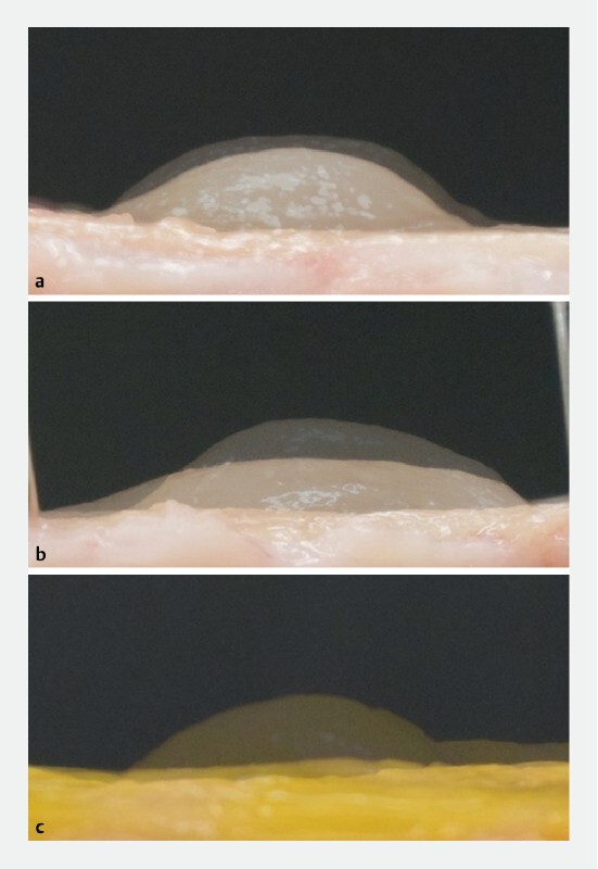 Fibrin Glue: Novel Submucosal Injection Agent For Endoscopic Submucosal 