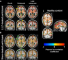 Functional MRI brain maps of resting-state functional connectivity in
representative age- and sex-matched participants. (A, B) Axial (top) and
coronal (bottom) views show whole-brain connectivity, with the seed at the
left (L) superior frontal region, in a 36-year-old female participant in the
low-level light therapy (LLLT) treatment group (A) and a 38-year-old female
participant in the sham treatment group (B) during the acute, subacute, and
late-subacute phases (columns, from left to right, in both A and B) of
traumatic brain injury recovery. (C) Axial (top left), coronal (bottom
left), and sagittal (right) views in a 38-year-old female control
participant are shown for comparison; the solid green circle in the sagittal
view indicates the location of the left superior frontal seed region. The
color bar indicates that brain regions with warm colors (red, orange,
yellow) show resting-state fluctuations that have significant positive
correlation (r of 0 to 1) with those of the left superior frontal region,
and brain regions with cold colors (blue) show resting-state fluctuations
that have significant negative correlation (r of −1 to 0) with those
of the left superior frontal region. Brain regions that have functional
connectivity with the left superior frontal seed in the LLLT-treated
participant (arrowheads in A) but not in the sham-treated participant
(arrowheads in B) are shown. The arrow in A additionally shows brain regions
with positive correlation with the seed in the LLLT-treated participant, but
negative correlation with the seed in the sham-treated participant (arrow in
B). All connections shown here achieved a false discovery
rate–adjusted P < .005.
