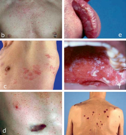 Figure: HIV/AIDS-associated diseases