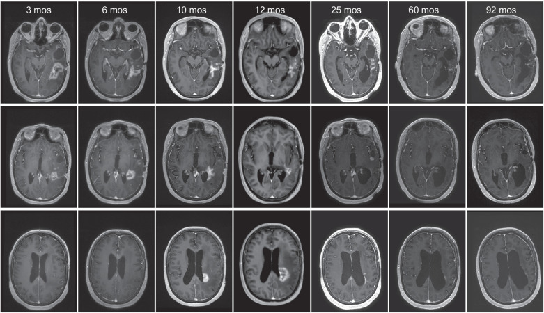 Figure 3. Illustrative case patient 15, a 40-year-old female who received 3 × 1010 vp for her second GBM recurrence, 13 months after initial diagnosis of an IDH mutant GBM. T1 after gadolinium images posttreatment demonstrated tumor regression of the virus-infused tumor site (top) after initial pseudoprogression, followed by a slow prolonged regression of the distant tumor sites (middle and bottom). One year after virus infusion patient neurologically deteriorated despite high-dose steroid treatment. Ultimately, she was bedridden with palliative care and all medication, including steroids, was withdrawn. After this she made a remarkable recovery, regaining a KPS of 70. Patient is still alive and in stable clinical condition 8 years after Delta24-RGD treatment without having had any other treatments.