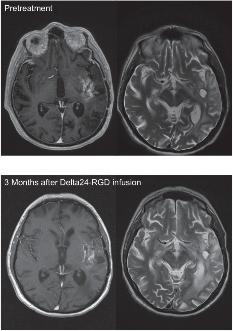 Figure 1. Illustrative case patient 7, a 67-year-old male with a second recurrence of a GBM, diagnosed 13 months earlier. Virus infusion of 1 × 109 vp was uncomplicated, but patient was readmitted 3 months later due to neurological deterioration. MR showed a decrease of the contrast-enhancing part of the tumor but an increase of the signal intensity in the peritumoral area on the T2- and FLAIR-images, interpreted as increased edema and stable tumor (left side: T1 after gadolinium; right side: T2 images). During hospitalization, patient deteriorated rapidly, dying with clinical signs of sepsis. At autopsy a diverticulitis with sigmoid perforation was found. Brain autopsy revealed a relatively small tumor in relation to the MR images, containing immune cell infiltrates (Fig. 5A), necrotic areas, infarctions, and absence of vascular proliferation.