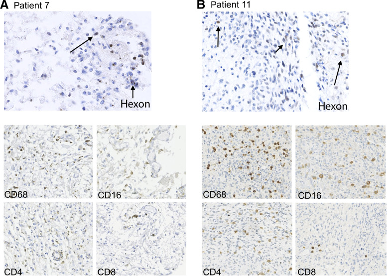 Figure 5. IHC analysis of post-mortem tumor material of patient 7 (A, 3 months after virus administration, left) and re-resection material of patient 11 (B, 4 weeks after virus administration, right) for the adenoviral protein hexon (top images), showing scattered hexon-positive cells and for the presence of immune cells (bottom images); CD68+ cells (macrophage marker), CD16+ (monocyte marker), and CD4+ lymphocytes are quite abundant in both samples. CD8+ lymphocytes are less frequent in both samples.