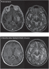 Figure 1. Illustrative case patient 7, a 67-year-old male with a second recurrence of a GBM, diagnosed 13 months earlier. Virus infusion of 1 × 109 vp was uncomplicated, but patient was readmitted 3 months later due to neurological deterioration. MR showed a decrease of the contrast-enhancing part of the tumor but an increase of the signal intensity in the peritumoral area on the T2- and FLAIR-images, interpreted as increased edema and stable tumor (left side: T1 after gadolinium; right side: T2 images). During hospitalization, patient deteriorated rapidly, dying with clinical signs of sepsis. At autopsy a diverticulitis with sigmoid perforation was found. Brain autopsy revealed a relatively small tumor in relation to the MR images, containing immune cell infiltrates (Fig. 5A), necrotic areas, infarctions, and absence of vascular proliferation.
