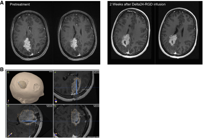 Figure 2. Illustrative case patient 11, a 48-year-old female, who was treated 21 months after GBM diagnosis for a second recurrence at dose level 4 with 1 × 1010 vp. After 2 weeks, MRI showed a large area with cavity formation suggestive of tumor lysis in the target area of one of the intratumoral catheters used for virus administration [A, T1 after gadolinium prior to treatment and 2 weeks after treatment; B, postoperative neuronavigation screenshot demonstrating the relation of the CED catheter (trajectory in blue) and the necrotic area]. Six weeks after virus infusion her preexisting paresis of the left leg deteriorated due to increasing mass effect of the treated tumor for which she underwent subtotal re-resection. After initial improvement, she deteriorated again 6 weeks later, at this point she declined further diagnostic tests and treatment. She died 106 days after virus infusion. PCR analysis of CSF samples demonstrated increasing virus titers 3 months post-infusion (Fig. 5). The resected tumor material contained besides tumor cells also viral proteins and immune cell infiltrates (Fig. 4B). Our routine tumor cell culture protocol of this tumor failed due to virus-induced lysis of tumor cells. Unfortunately, we were unable to discriminate between true tumorprogression or an inflammatory reaction known as pseudoprogression.