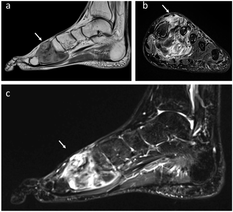 Malignant Bone and Soft Tissue Lesions of the Foot - PMC