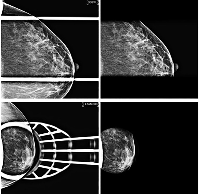 Examples include (top) a 49-year-old White woman with right mediolateral oblique diagnostic mammogram with large spot compression paddle (Breast Imaging Reporting and Data System [BI-RADS] 1) and (bottom) a 40-year-old White woman with left craniocaudal diagnostic mammogram with small spot compression paddle (BI-RADS 4), followed by US-guided biopsy with benign results. This includes special magnification and spot compression views (left) with resultant extracted images of tissue inside the paddle (right) that were achieved using histogram analysis. Extracted tissue was saved as a pixel mask corresponding to the original mammogram.