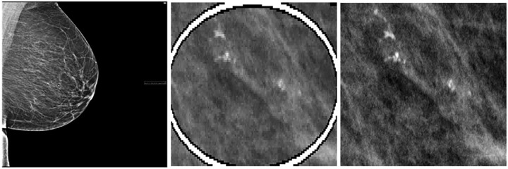 Sample region of interest (ROI) extraction from a 43-year-old African American woman with right craniocaudal screening mammogram, Breast Imaging Reporting and Data System (BI-RADS) 0, followed by US-guided biopsy resulting in a diagnosis of ductal carcinoma in situ. Left: Low-resolution screen save copy of mammogram containing a burned-in ROI annotated by the interpreting radiologist. Middle: Deep learning–based ROI detection and coordinate extraction from the screen save image. Right: Matching original mammogram is found using image comparison from the Python Simple ITK library, and the coordinates of the ROI are mapped to the original image.