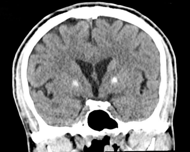 The Anterior Globus Pallidus Externus of Basal Ganglia as Primarily a ...