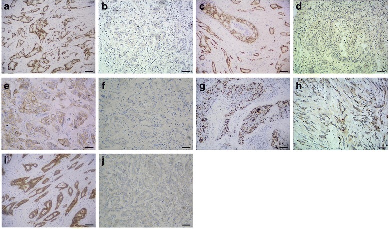 E-cadherin Expression Phenotypes Associated With Molecular Subtypes In 