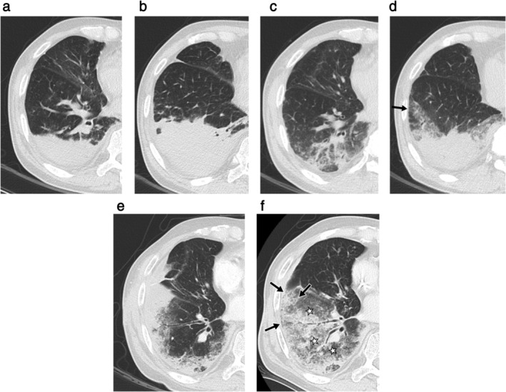 Invasive mucinous adenocarcinoma of the lung: Serial CT findings ...