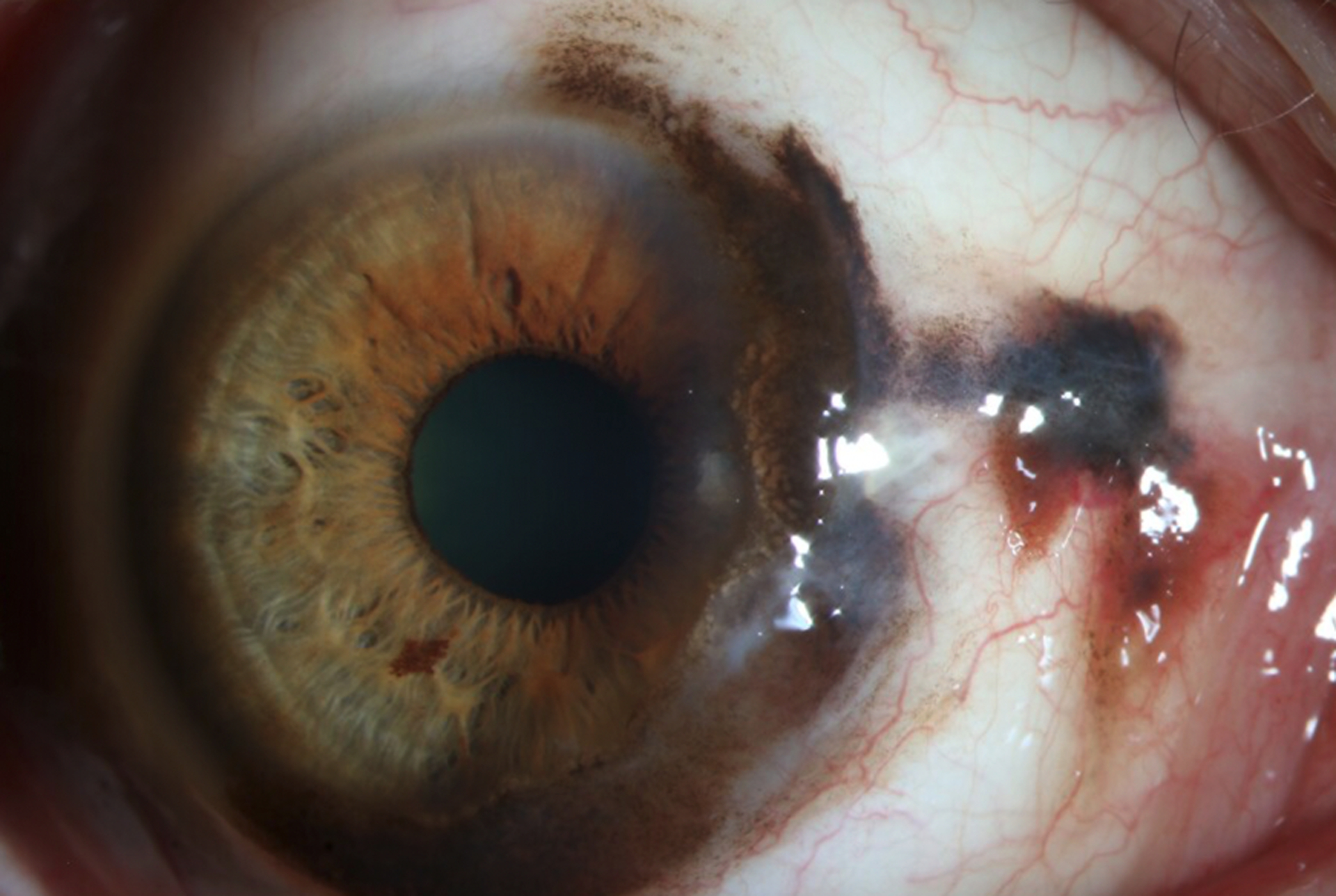 Conjunctival Nevus - PMC