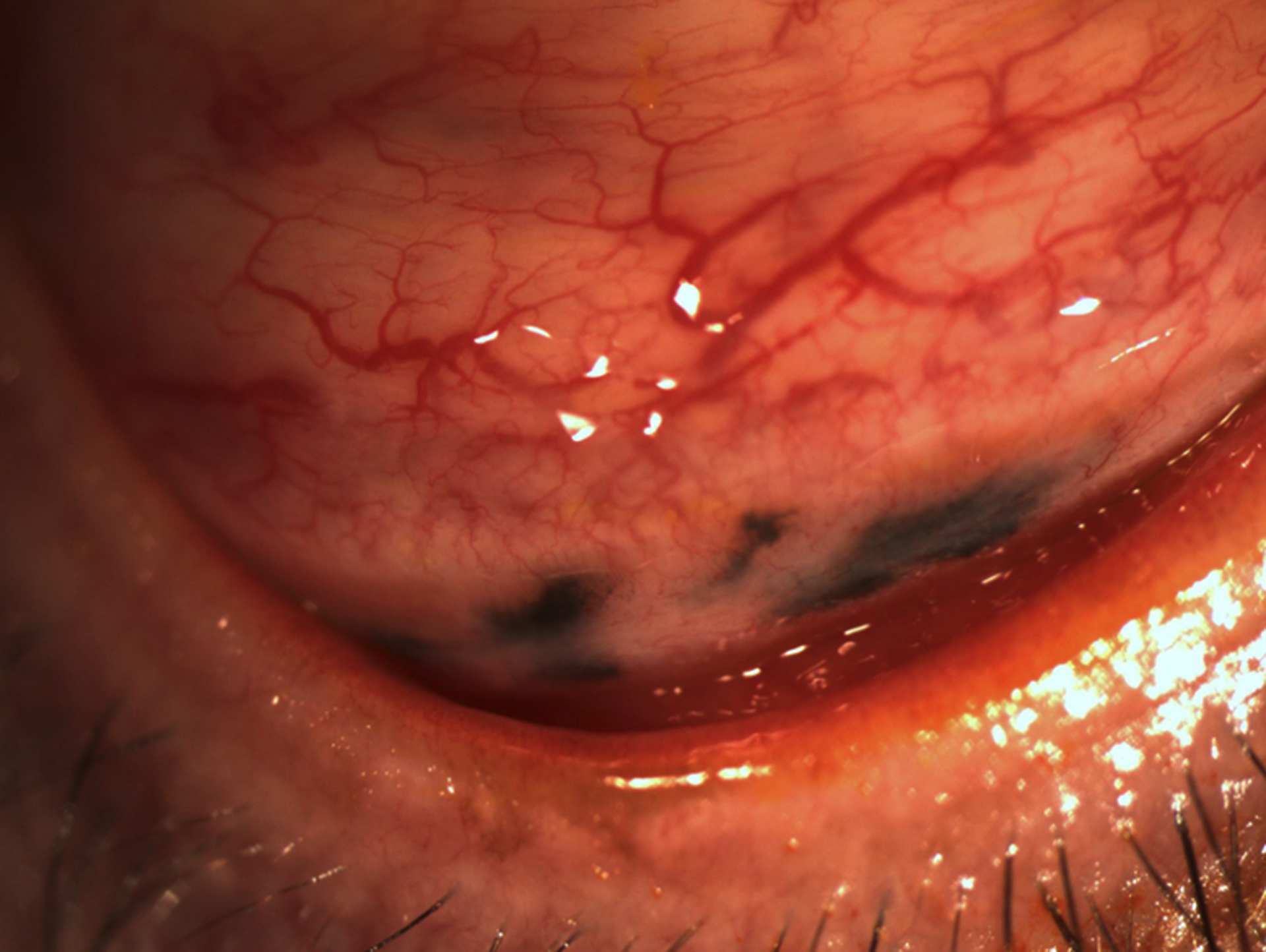 Conjunctival Nevus - PMC