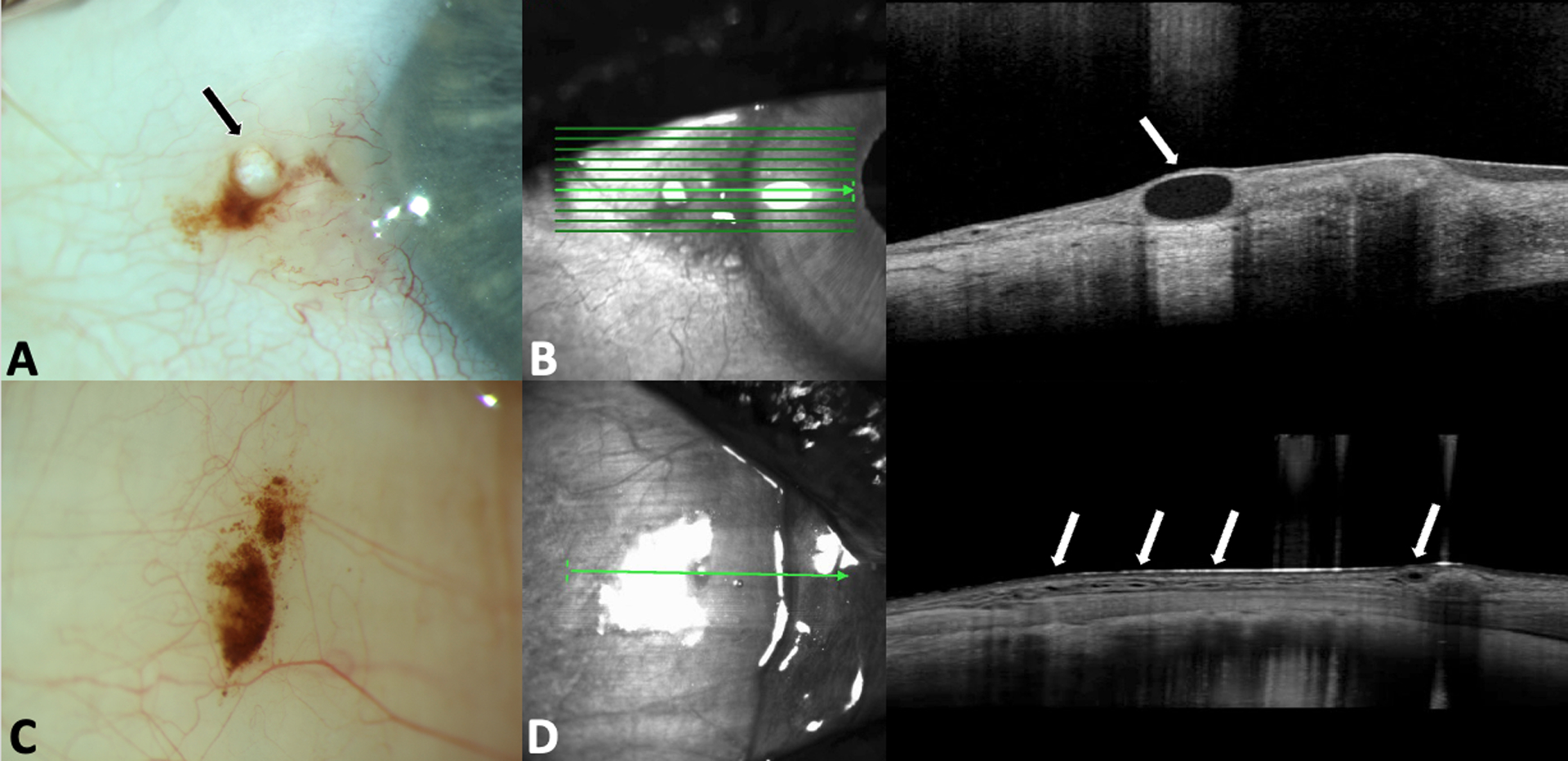 Conjunctival Nevus - PMC