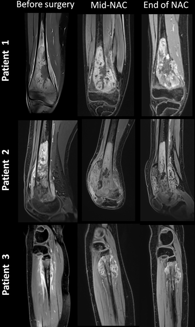 MR images (postcontrast T1 with fat suppression, coronal plane [patient 1], and sagittal plane [patients 2 and 3]) in three different patients treated for osteosarcoma with neoadjuvant chemotherapy (NAC) and surgery at different timepoints (before surgery; after the administration of methotrexate, ifosfamide, and etoposide; and at the end of NAC). Patient 1 (male, aged 14 years) had a stable tumor volume throughout follow-up, with the disappearance of bone edema from the first MRI control. After surgery, histologic evaluation showed less than 1% viable cells (Huvos 4). Both patients 2 (female, aged 15 years) and 3 (female, aged 12 years) showed an increase in tumor volume in the first control followed by a decrease. However, histologic evaluation showed more than 60% viable cells for patient 2 (Huvos 2) and less than 1% (Huvos 1) for patient 3.