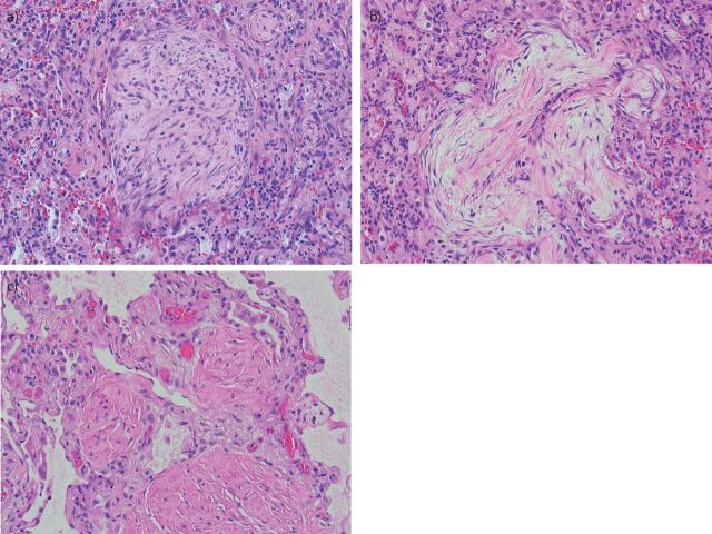 Cryptogenic organising pneumonia: current understanding of an enigmatic ...