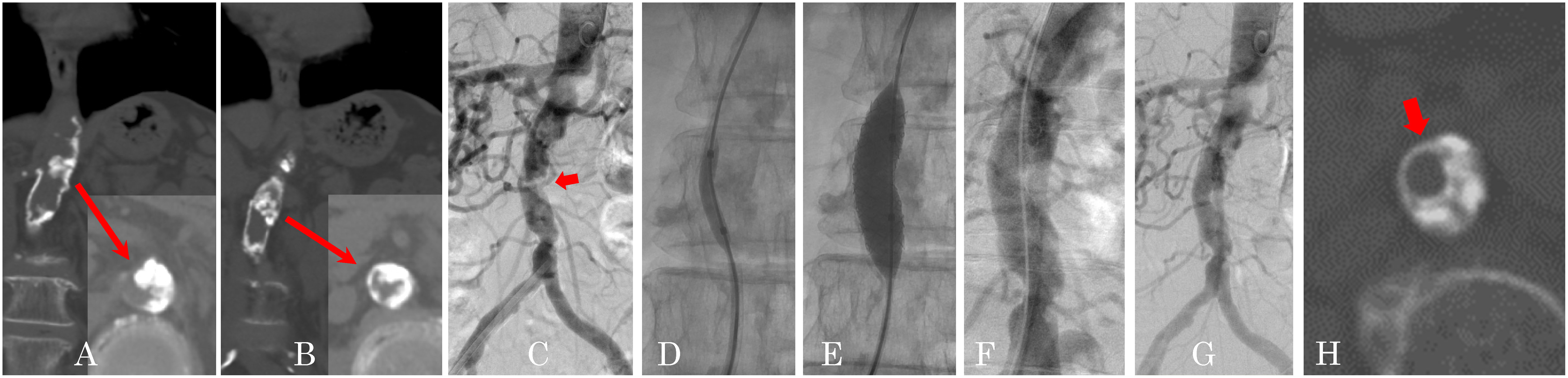 Fig. 2 Endovascular treatment for coral reef aorta with VIABAHN VBX (Case 2).