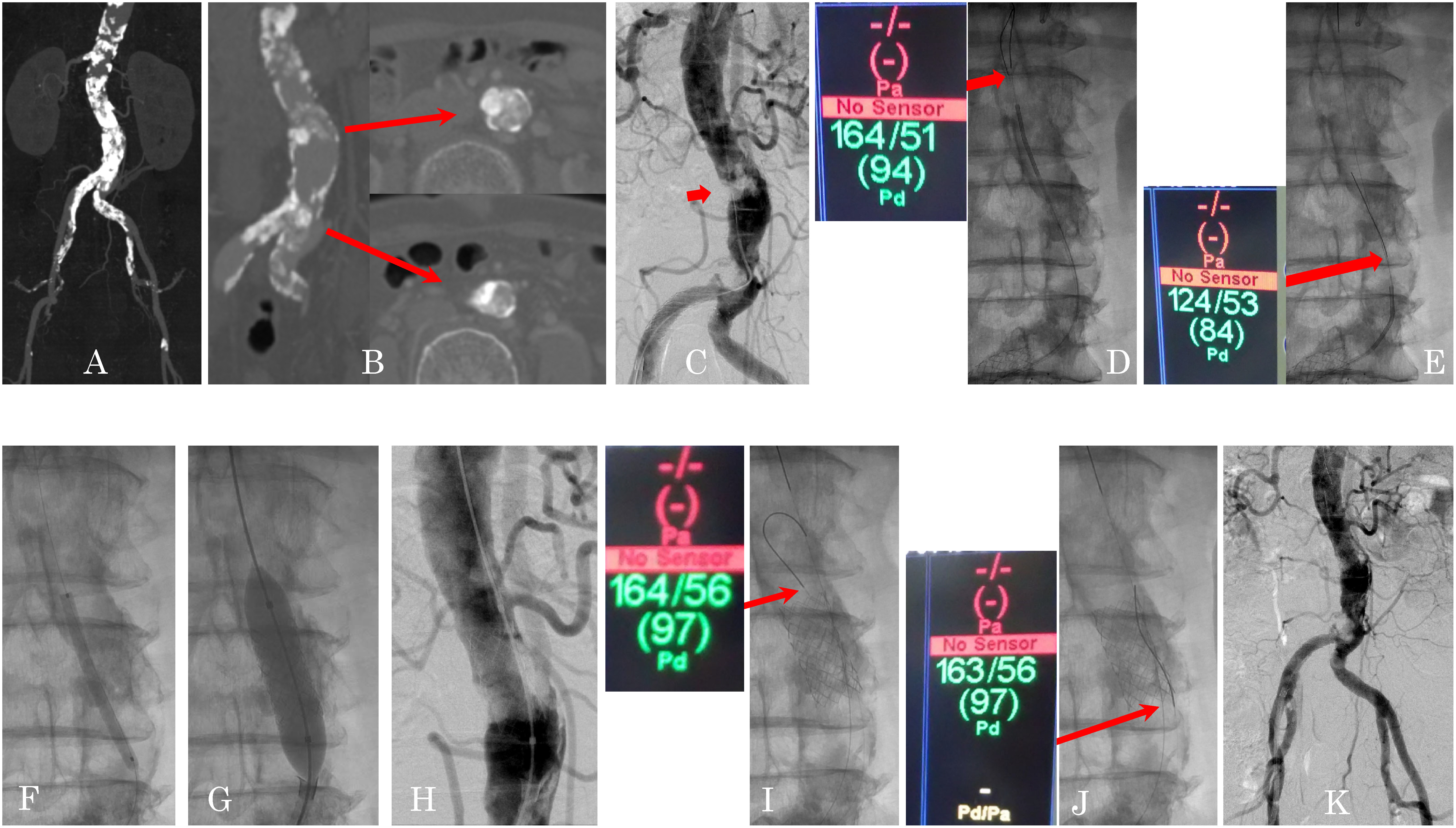 Fig. 1 Endovascular treatment for coral reef aorta with VIABAHN VBX (Case 1).