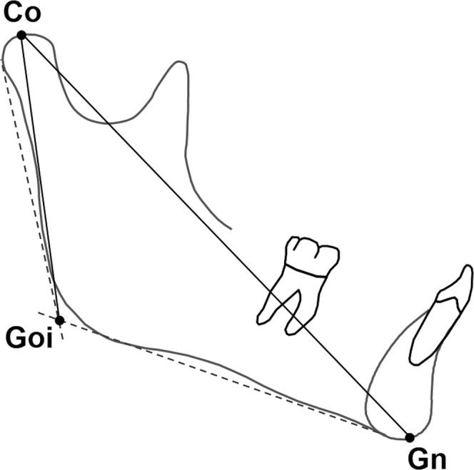 Figure 1. Mandibular growth parameters. Identified landmarks: Co, Condylion; Goi, Gonion Intersection; and Gn, Gnathion. Goi was defined as the point of intersection between the mandibular and ramus planes.