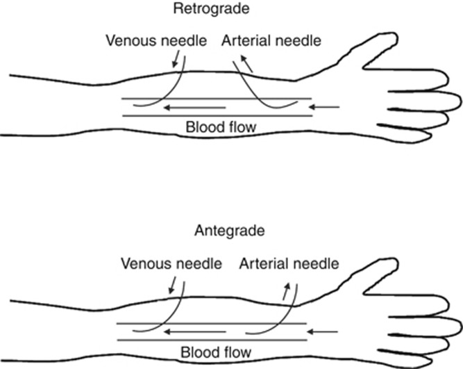 Cannulation technique influences arteriovenous fistula and graft ...