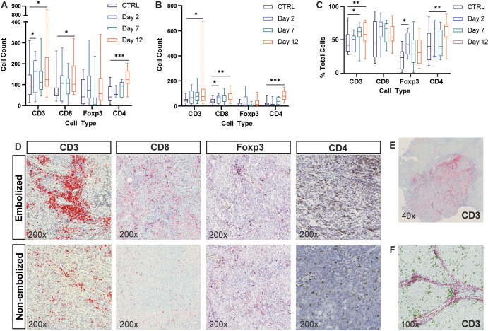 Transarterial embolization induces increased lymphocyte infiltration in embolized tumors. Box and whisker plots show (A) the average number of CD3+, CD8+, FOXP3+, and CD4+ cells (intrastromal and intratumoral cells) at 2 days (n = 7), 7 days (n = 12), and 12 days (n = 17) after embolization relative to control (CTRL) tumors that were not embolized (n = 12); (B) the average number of cells within the intratumoral compartment of embolized tumors at 2, 7, and 12 days after embolization relative to control tumors that were not embolized; and (C) the average percentage of immune cells found within the intratumoral compartment expressed as a percentage of total number of cells (intrastromal plus intratumoral cells) at 2, 7, and 12 days after embolization relative to control tumors that were not embolized. Whiskers indicate maximum and minimum values. Boxes extend from the 25th to 75th percentiles. The line in the middle of the box is plotted at the median. * = P < .05, ** = P < .01, and *** = P < .001 according to the generalized estimating equation model. Significant P values (left to right): in A, .02, .03, .01, <.001; in B, .02, .02, .001, <.001; and in C, .02, .007, .01, .002. (D) Representative images of histologic staining of CD3, CD8, FOXP3, and CD4 cell markers in embolized and control tumors. (E) Representative low-magnification image shows CD3+ cell infiltration into a hepatocellular carcinoma (HCC) tumor 12 days after embolization. (F) Representative image demonstrates intrastromal CD3+ cells (pink markers) and intratumoral CD3+ cells (green markers) within HCC specimens.