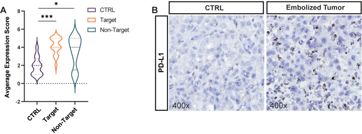 Transarterial embolization induces increased expression of programmed cell death protein ligand-1 (PD-L1) by hepatocellular carcinoma cells. (A) Violin plot shows the average expression score of PD-L1 as determined with in situ hybridization (ISH) in untreated control tumors (CTRL) (n = 12), embolized tumors (target) (n = 17), and nontarget tumors (n = 8) in rats that underwent embolization. Tissues were collected for analysis 12 days after embolization. Bold dotted lines indicate medians, and thin dotted lines indicate quartiles. * = P < .05 and *** = P < .001 according to the general estimating equation model. Significant P values: <.001 (left), .02 (right). (B) Representative images of PD-L1 ISH (3,3’-diaminobenzidine stain [brown stain]) in embolized tumors and untreated control tumors that were not embolized. Sections have been counterstained with hematoxylin to mark cell nuclei.