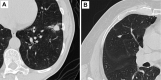 Representative axial CT images of pulmonary nodules included in the
study. (A) Malignant nodule with a lung cancer prediction score of 10. (B)
Benign nodule with a lung cancer prediction score of 2.