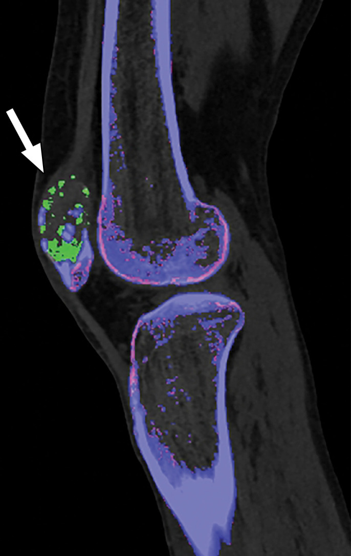 Appropriate selection of postprocessing attenuation threshold. Sagittal color overlay MD-urate images obtained with dual-source DECT for gout evaluation show monosodium urate deposition (green) in the soft tissue associated with the lytic lesion involving the patella (arrow). Image processed using 120 HU as the minimum attenuation threshold (a) shows a larger (6.77 cm3) and more accurate representation of the tophus deposit compared with the image processed using 150 HU as the threshold (b) (3.39 cm3).