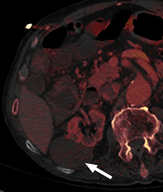 Optimization of window settings for MD-iodine images. (a) Axial single-energy–equivalent image shows a simple fluid-attenuation cyst in the right kidney (arrow). (b) Axial color overlay MD-iodine image shows spurious uptake of iodine (dark red) by the cyst (arrow) due to improper window settings. Also note the false presence of iodine in the gallbladder (*), subcutaneous fat (arrowhead), and air. (c) Axial color overlay MD-iodine image with appropriate window display shows lack of iodine in the cyst (arrow).