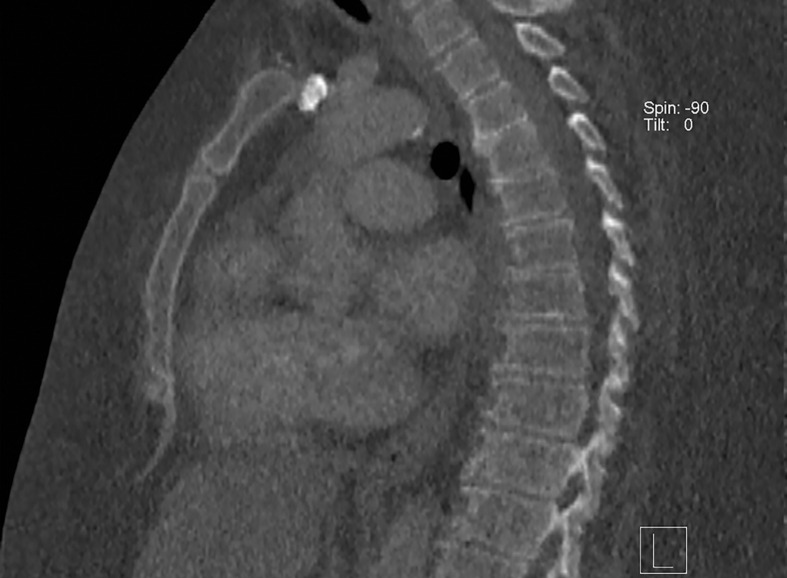 Importance of protocol selection. Sagittal single-energy–equivalent CT images of the thorax in a 280-lb (127-kg) patient, obtained with dual-source DECT at the same window display setting at two time points. The images were acquired at tube voltages of 80/140 kVp tin filter (Sn) (volumetric CT dose index = 10 mGy) (a) and 100/150 kVp Sn (volumetric CT dose index = 25 mGy) (b). Image quality is superior in b compared with in a owing to improved photon flux and penetration, at the expense of higher radiation dose.