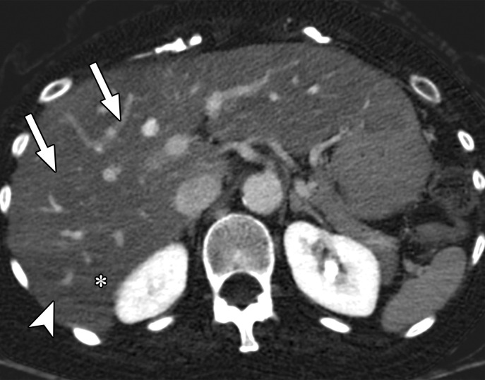 Beam hardening due to arm positioning. (a) Topographic image obtained for abdominopelvic CT with a dual-layer DECT scanner, which processes DECT images in the projection domain, shows that the patient was scanned in the "right arm down" position. (b, c) Axial conventional single-energy (b) and gray-scale MD-iodine (c) images show dark streaks (arrows) and bands (arrowhead) extending from the humerus, which degrade image quality and cause spurious lower attenuation and iodine distribution in the posterior hepatic segment (* in c).