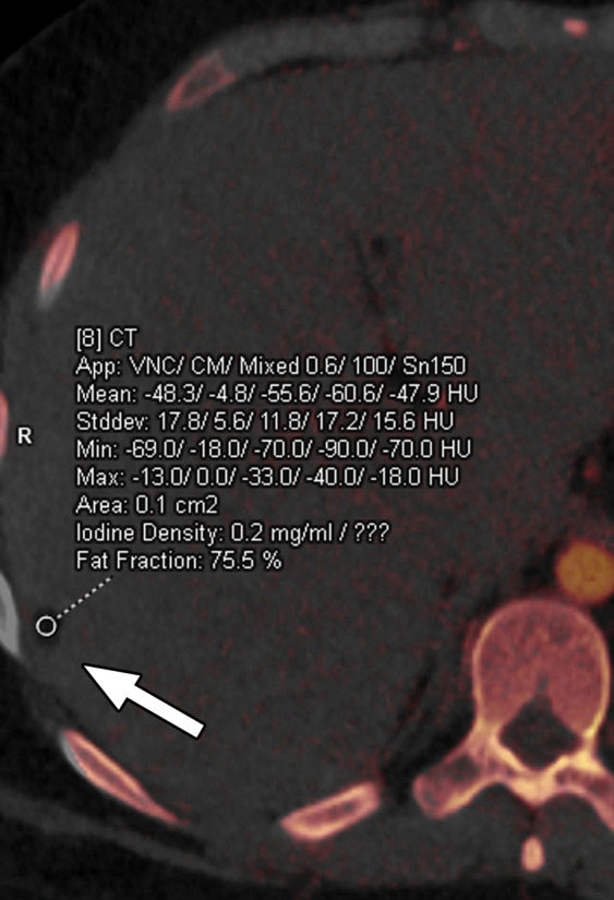 Constrained spectral FOV for the abdomen. Axial portovenous phase dual-source DECT images in a 20-year-old man with tuberous sclerosis. (a) Color overlay MD-fat image shows an 8-mm liver lesion (arrow) just within the limits of the spectral FOV. The limits of the FOV are sharply demarcated, and patient anatomy outside the field (arrowheads) is not color coded (ie, has no spectral information). (b) MD-iodine image shows no iodine uptake qualitatively or quantitatively (0.2 mg/mL) within the lesion (arrow), and quantitation confirms the presence of fat (75%), suggestive of angiomyolipoma. Material analysis of the lesion was possible because it lay within the spectral FOV.