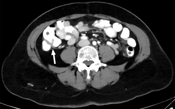 Optimization of window settings for virtual monochromatic (VMC) images. Axial portovenous phase abdominopelvic CT images obtained with iodinated oral contrast medium (*) show the bowel wall and folds (arrow). (a) A 120-kVp image at window width (WW) of 360 HU and window level (WL) of 60 HU. (b) A 40-keV VMC image at the same window settings shows significant "blooming" of contrast medium, hindering visualization of the bowel wall and folds. (c) A 40-keV VMC image at wider window settings (WW = 589 HU, WL = 88 HU) provides optimal display.