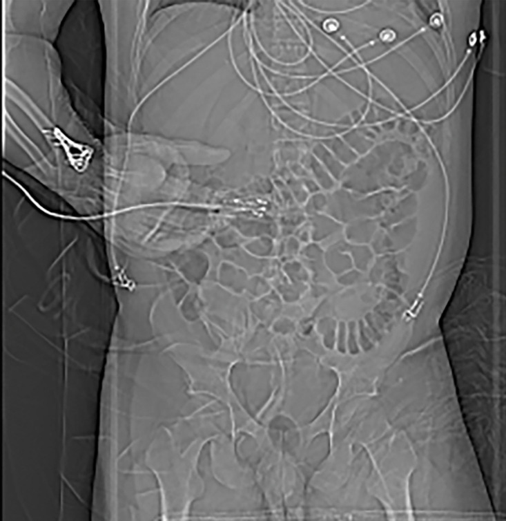 Beam hardening due to arm positioning. (a) Topographic image obtained for abdominopelvic CT with a dual-source scanner, which processes DECT images in the image domain, shows that the patient was scanned in the "right arm down" position. (b) Axial single-energy–equivalent image shows dark streaks (arrows) emanating from the humerus that extend across the liver and spleen. Dotted circle = spectral FOV. (c) On an axial color overlay MD-iodine image, the streaks (arrows) also affect depiction of iodine distribution. Even though the posterior hepatic segment (*) and spleen (arrowhead) lie within the spectral FOV (dotted circle), they artifactually show lack of iodine uptake, which can mimic a parenchymal infarct.