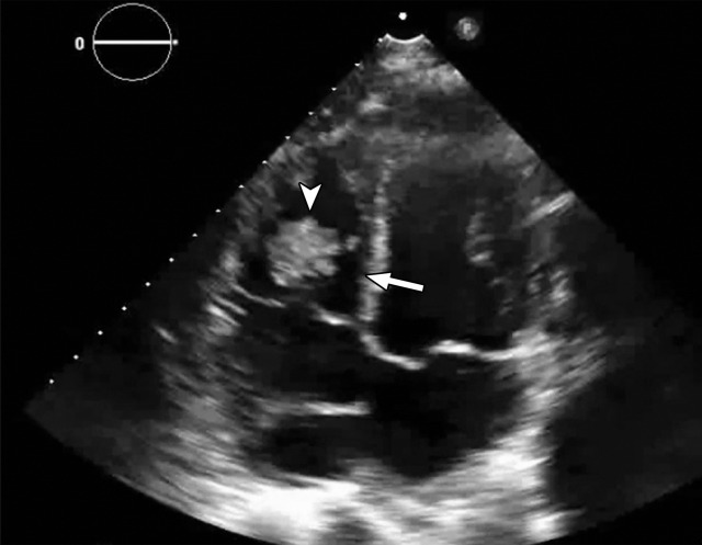 Temporal misregistration on images obtained with dual-source DECT. (a) Axial pulmonary CT angiogram from the 150-kVp Sn projection shows a subtle filling defect (arrowhead) in the right ventricle (arrow). (b) Axial single-energy–equivalent pulmonary CT angiogram, which contains projections from both voltages, shows no filling defect in the right ventricle (arrow). (c) Axial single-energy (120-kVp) abdominal CT image obtained on the same day clearly shows a filling defect (arrowhead) in the right ventricle (arrow). (d) Echocardiogram shows a thrombus (arrowhead) in the right ventricle (arrow). Nonvisualization of the thrombus at DECT was due to temporal offset between the two x-ray tubes.