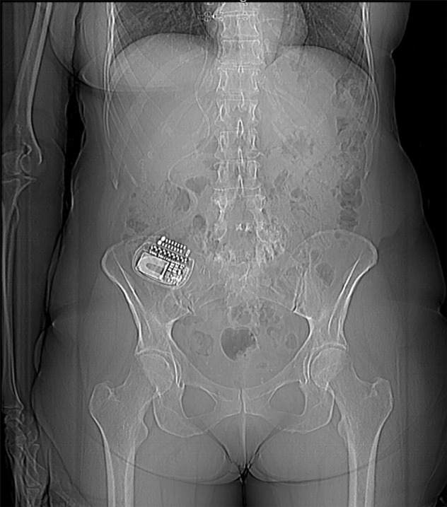 Beam hardening due to arm positioning. (a) Topographic image obtained for abdominopelvic CT with a dual-layer DECT scanner, which processes DECT images in the projection domain, shows that the patient was scanned in the "right arm down" position. (b, c) Axial conventional single-energy (b) and gray-scale MD-iodine (c) images show dark streaks (arrows) and bands (arrowhead) extending from the humerus, which degrade image quality and cause spurious lower attenuation and iodine distribution in the posterior hepatic segment (* in c).