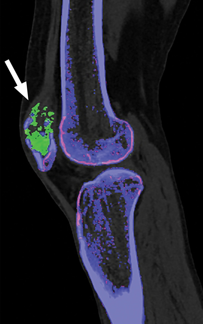 Appropriate selection of postprocessing attenuation threshold. Sagittal color overlay MD-urate images obtained with dual-source DECT for gout evaluation show monosodium urate deposition (green) in the soft tissue associated with the lytic lesion involving the patella (arrow). Image processed using 120 HU as the minimum attenuation threshold (a) shows a larger (6.77 cm3) and more accurate representation of the tophus deposit compared with the image processed using 150 HU as the threshold (b) (3.39 cm3).