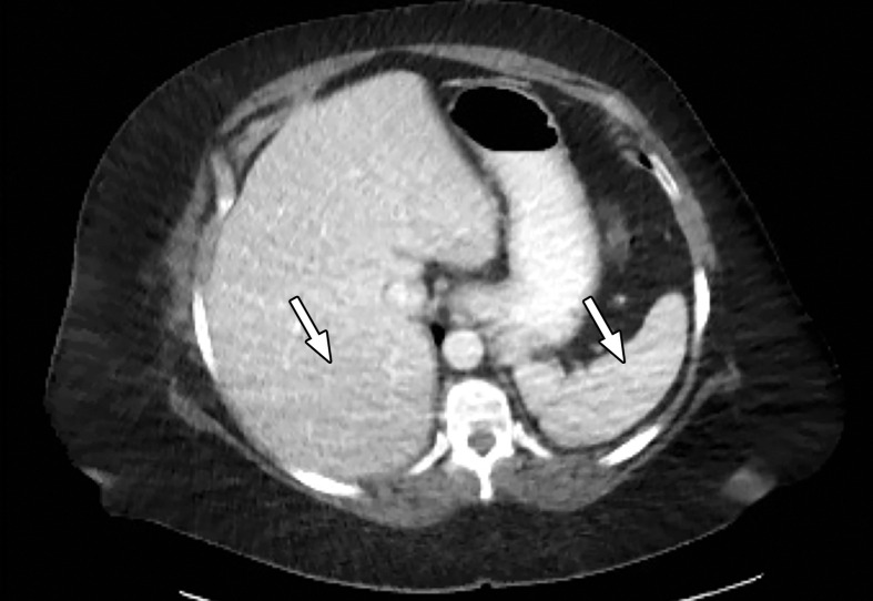 Photon starvation in a large patient. Axial portovenous phase abdominopelvic CT was performed in a 242-lb (110-kg) patient using rapid kilovolt peak (kVp) switching DECT. (a) Material density (MD)–iodine image shows dark bands of artifact (arrows) across the liver and spleen. (b) On an MD-water image, the streaks appear as bright bands (arrows). (c) On a 65 kilo–electron volt (keV) image, the artifacts are much less apparent (arrows). (d) On a 140 kVp–equivalent image, the artifacts are not visualized.