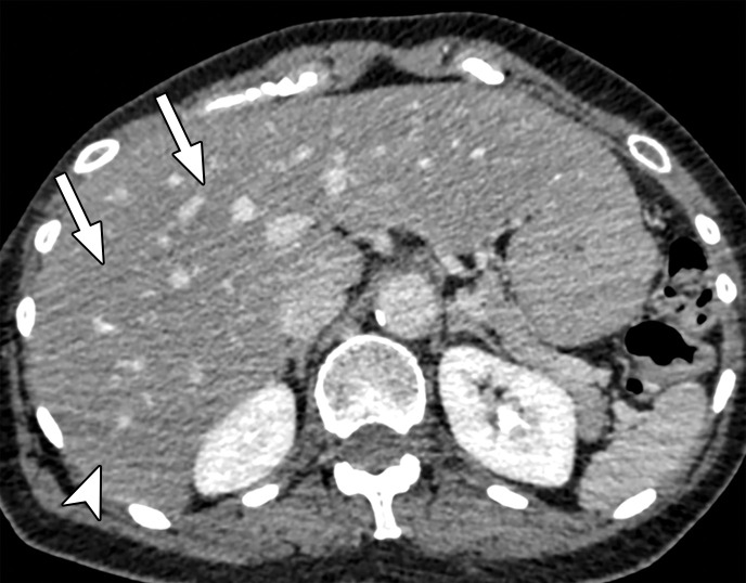 Beam hardening due to arm positioning. (a) Topographic image obtained for abdominopelvic CT with a dual-layer DECT scanner, which processes DECT images in the projection domain, shows that the patient was scanned in the "right arm down" position. (b, c) Axial conventional single-energy (b) and gray-scale MD-iodine (c) images show dark streaks (arrows) and bands (arrowhead) extending from the humerus, which degrade image quality and cause spurious lower attenuation and iodine distribution in the posterior hepatic segment (* in c).