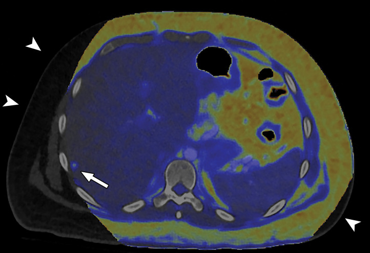 Constrained spectral FOV for the abdomen. Axial portovenous phase dual-source DECT images in a 20-year-old man with tuberous sclerosis. (a) Color overlay MD-fat image shows an 8-mm liver lesion (arrow) just within the limits of the spectral FOV. The limits of the FOV are sharply demarcated, and patient anatomy outside the field (arrowheads) is not color coded (ie, has no spectral information). (b) MD-iodine image shows no iodine uptake qualitatively or quantitatively (0.2 mg/mL) within the lesion (arrow), and quantitation confirms the presence of fat (75%), suggestive of angiomyolipoma. Material analysis of the lesion was possible because it lay within the spectral FOV.