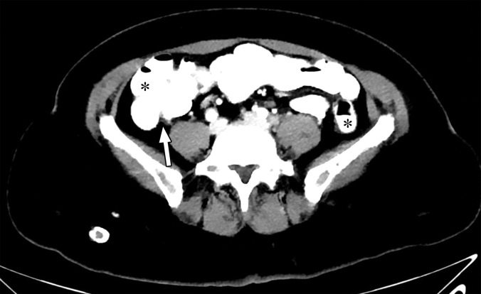 Optimization of window settings for virtual monochromatic (VMC) images. Axial portovenous phase abdominopelvic CT images obtained with iodinated oral contrast medium (*) show the bowel wall and folds (arrow). (a) A 120-kVp image at window width (WW) of 360 HU and window level (WL) of 60 HU. (b) A 40-keV VMC image at the same window settings shows significant "blooming" of contrast medium, hindering visualization of the bowel wall and folds. (c) A 40-keV VMC image at wider window settings (WW = 589 HU, WL = 88 HU) provides optimal display.