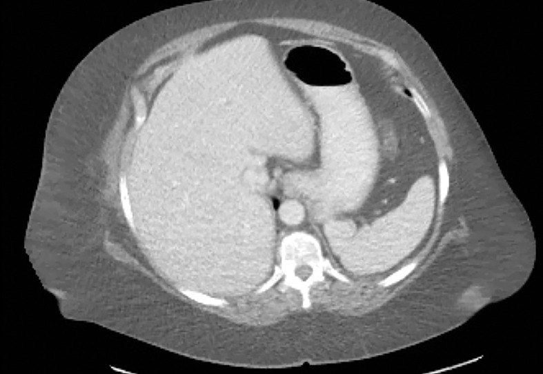 Photon starvation in a large patient. Axial portovenous phase abdominopelvic CT was performed in a 242-lb (110-kg) patient using rapid kilovolt peak (kVp) switching DECT. (a) Material density (MD)–iodine image shows dark bands of artifact (arrows) across the liver and spleen. (b) On an MD-water image, the streaks appear as bright bands (arrows). (c) On a 65 kilo–electron volt (keV) image, the artifacts are much less apparent (arrows). (d) On a 140 kVp–equivalent image, the artifacts are not visualized.