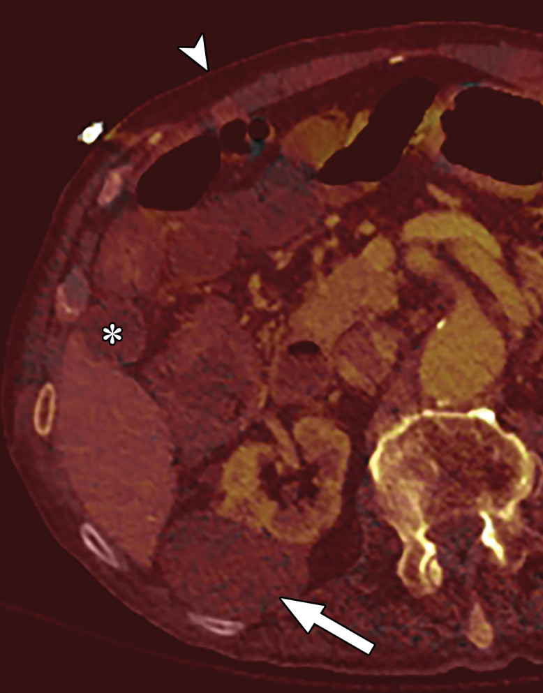 Optimization of window settings for MD-iodine images. (a) Axial single-energy–equivalent image shows a simple fluid-attenuation cyst in the right kidney (arrow). (b) Axial color overlay MD-iodine image shows spurious uptake of iodine (dark red) by the cyst (arrow) due to improper window settings. Also note the false presence of iodine in the gallbladder (*), subcutaneous fat (arrowhead), and air. (c) Axial color overlay MD-iodine image with appropriate window display shows lack of iodine in the cyst (arrow).