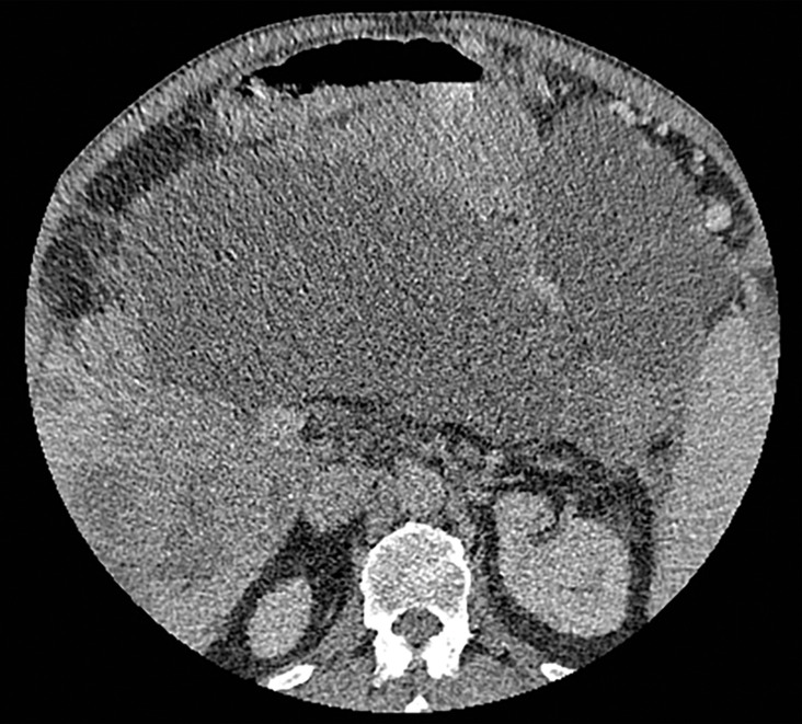 Constrained spectral field of view (FOV). Axial abdominopelvic CT images obtained in a 233-lb (106-kg) patient with a second-generation dual-source DECT scanner. (a, b) Image acquired at 100 kVp (a) has a larger FOV (50 cm) than an image acquired at 140 kVp Sn (33 cm) (b) owing to a difference in associated detector size. (c) Single-energy–equivalent image shows that the high-kVp tube-detector constrains the spectral FOV, which is limited to the area within the dotted circle, and also degrades the image quality of structures that lie outside the spectral FOV (arrows). (d) On a color overlay MD-iodine image, the constrained spectral FOV limits the anatomic area (within the dotted circle) for which qualitative and quantitative material-specific information (eg, iodine distribution) can be obtained. (e) On a virtual noncontrast (VNC) image, the areas outside the spectral FOV (dotted circle) show spurious high attenuation (arrows).